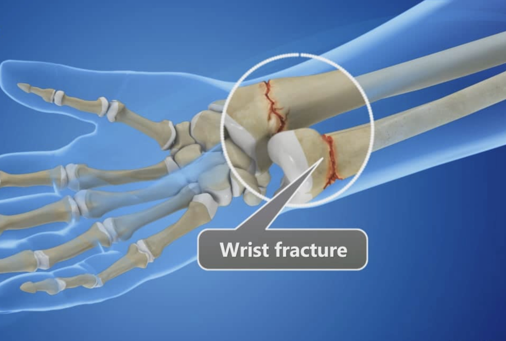 complete bone fracture
